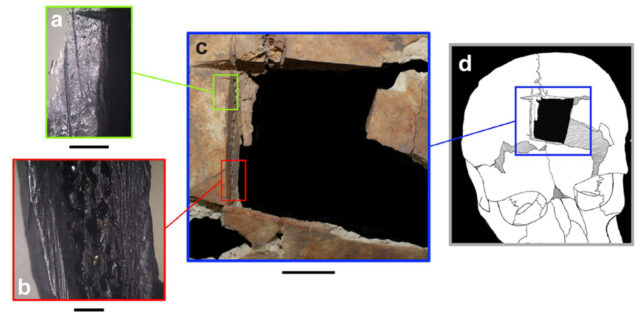 схема могильного черепа Меггідо зі слідами трепанації