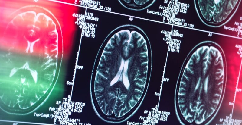 Хвороба Альцгеймера може насправді не бути хворобою мозку