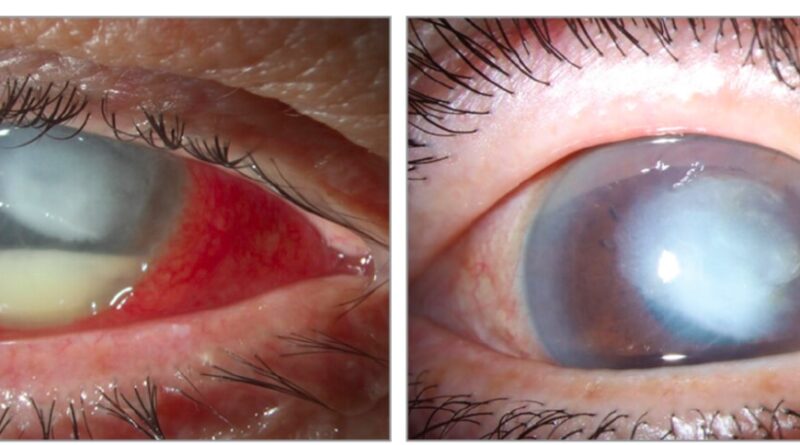 У США зростає кількість загиблих від очних крапель, заражених синьогнійною паличкою