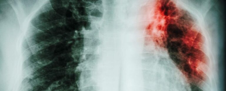 У Європі знову зростає смертність від туберкульозу