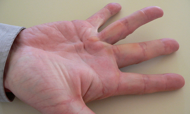 Рука людини з контрактурою Дюпюітрена.