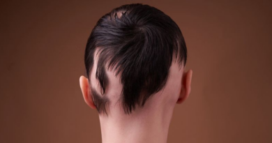Схвалено новий препарат від випадіння волосся: відновлює 80% волосся у деяких пацієнтів з алопецією