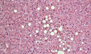 Різке схуднення покращило стан печінки при її жировому переродженні