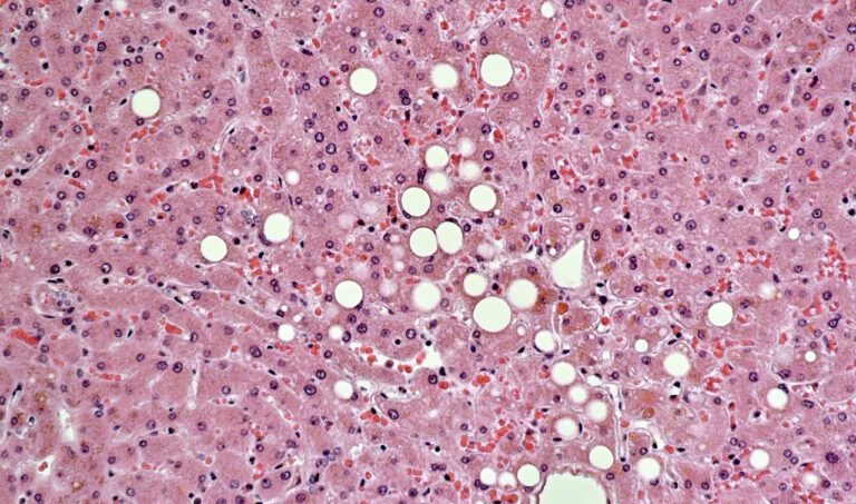 Різке схуднення покращило стан печінки при її жировому переродженні