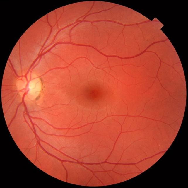 Фото задньої частини ока, на якому видно зоровий нерв.