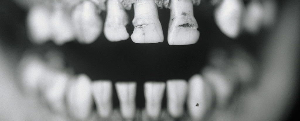 Зуби можуть зберігати сигнал патогенних мікроорганізмів сотні років, - дослідження