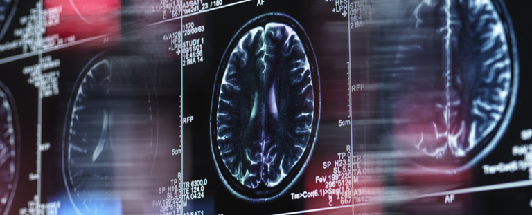 Експерт з Альцгеймера пояснює, як генетичні мутації можуть сповільнити розвиток хвороби