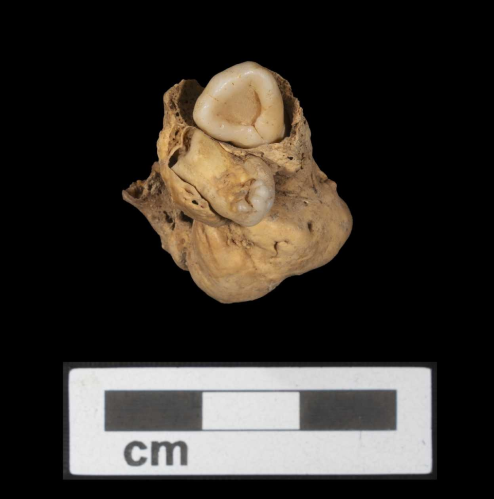 Вчені знайшли пухлину з зубів у тазу давнього єгиптянина