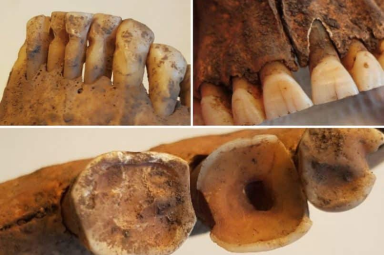 Вікінги страждали від карієсу і намагалися його лікувати