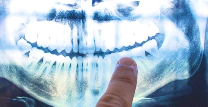 Причина хвороби Альцгеймера може критися у вашому роті