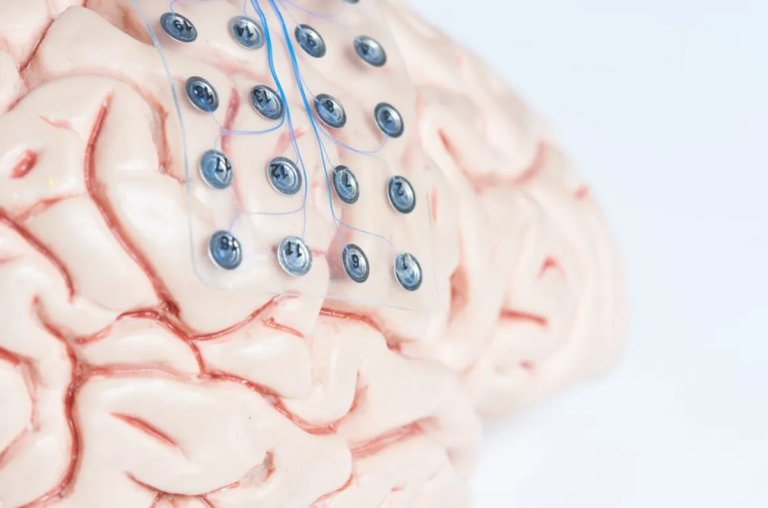 Перший у світі імплантат мозку для лікування епілепсії виявився життєво важливим