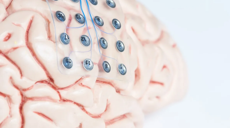 Перший у світі імплантат мозку для лікування епілепсії виявився життєво важливим