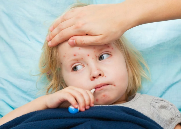 ВООЗ повідомляє, що в Європі захворюваність на кір зросла у 45 разів