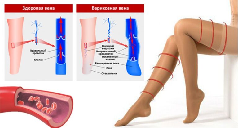 Компресійна терапія: Турбота про здоров'я та комфорт