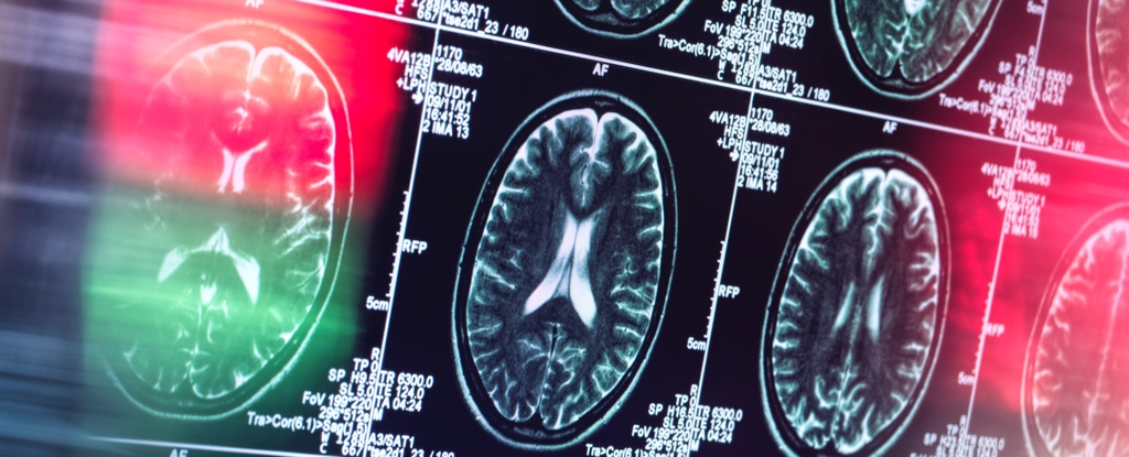Вчені відкрили 2 ключові системи мозку, що стоять за психозом