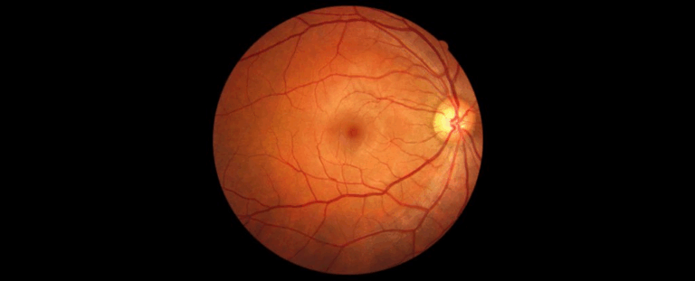 Дослідження показало, що стан судин сітківки може сигналізувати про ризик деменції в середньому віці