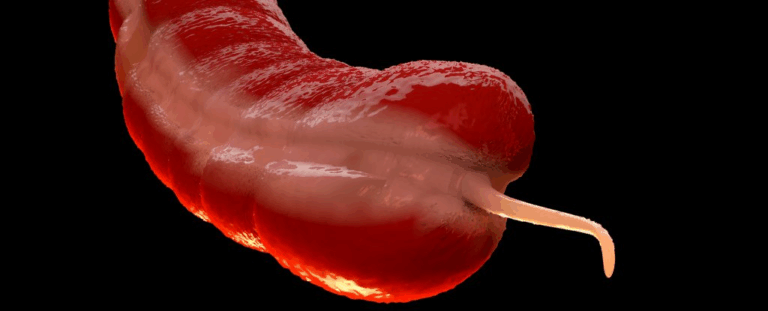 Рак апендикса стає дедалі частішим серед молоді: що відомо про нову тривожну тенденцію