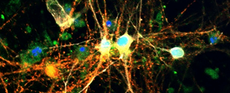 Зберігання глюкози у мозку може відігравати більшу роль у розвитку хвороби Альцгеймера, ніж вважали раніше