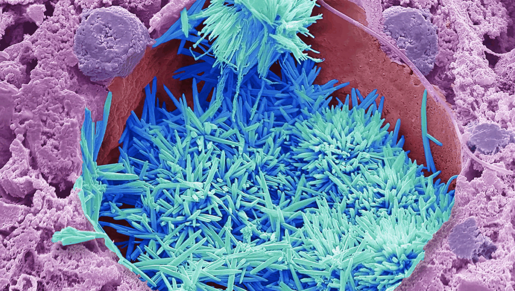 Нагородами відзначена фотографія холестерину в тканині печінки СТІВ ГШМАЙСНЕР