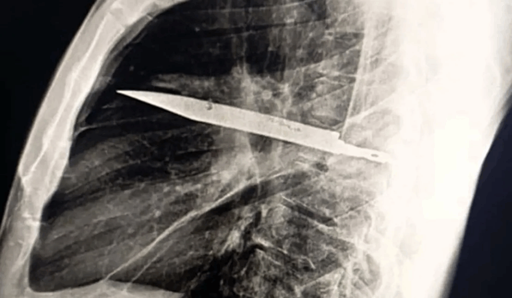 У Танзанії чоловік прожив 8 років із ножем у грудях і не здогадувався про це