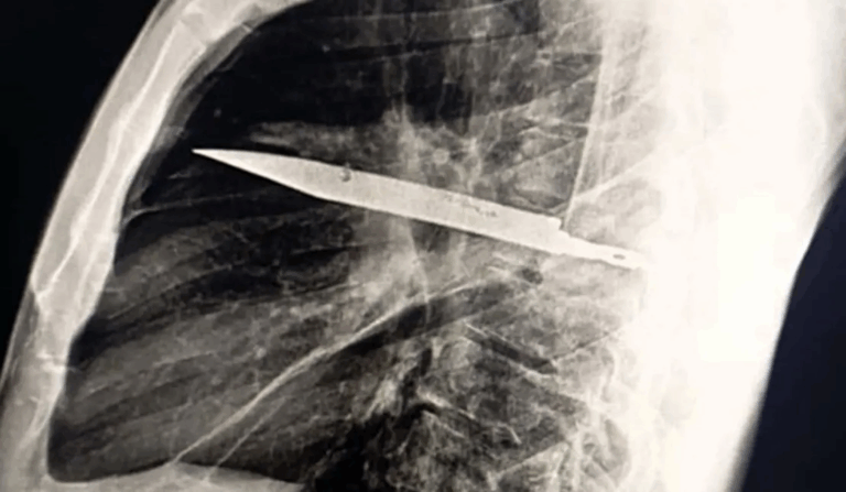 У Танзанії чоловік прожив 8 років із ножем у грудях і не здогадувався про це