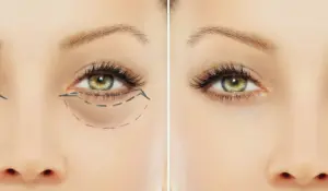 Блефаропластика – погляд, який відкриває нові можливості