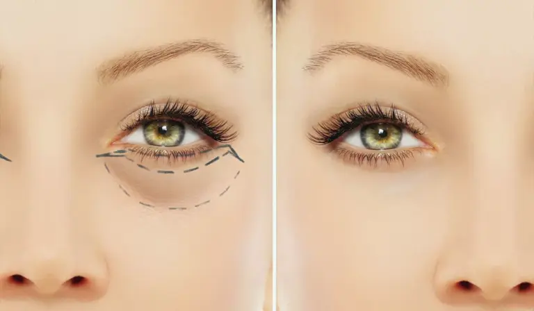 Блефаропластика – погляд, який відкриває нові можливості